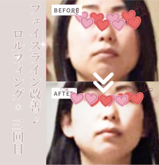 フェイスライン Before/After